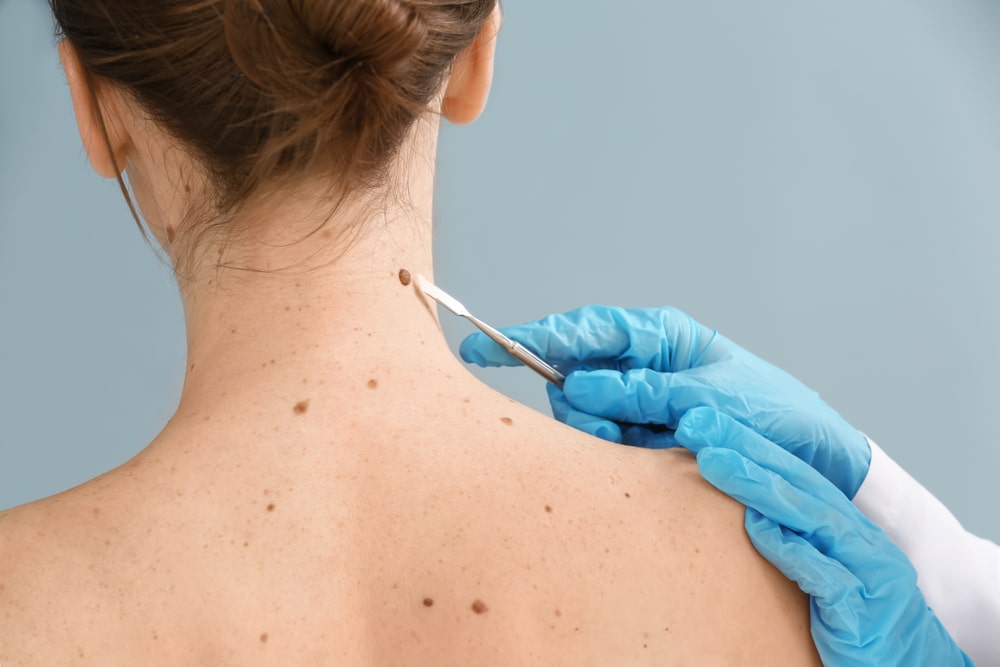 A woman getting a mole check in Lubbock, TX