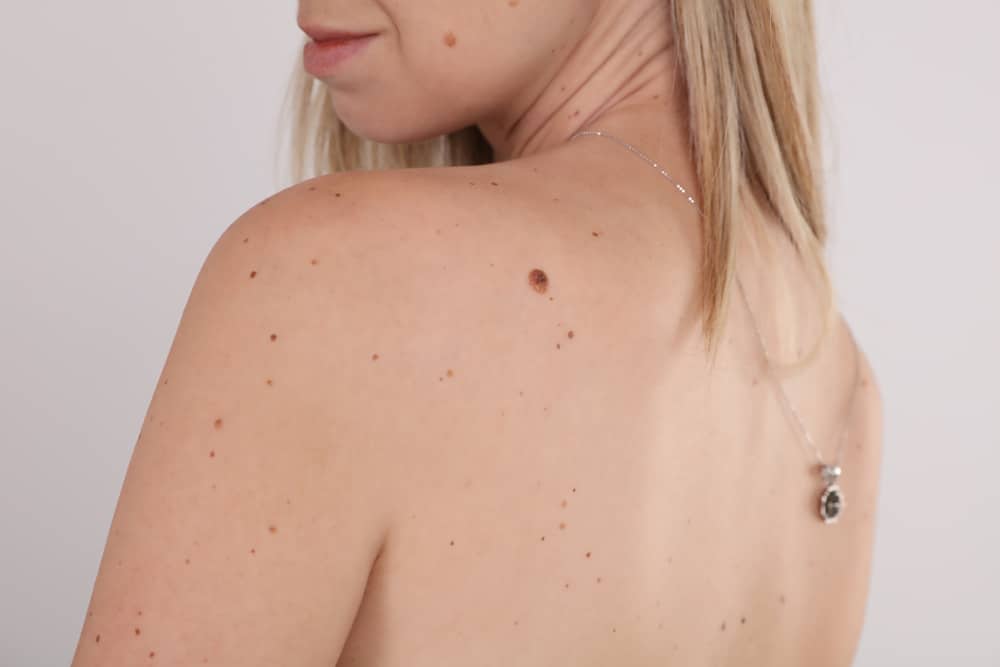 A cropped shot of a mole on a woman's back